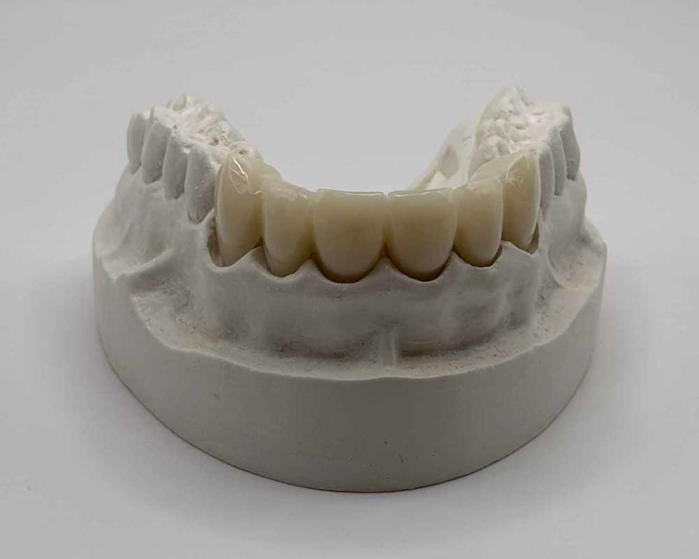 Whittier Palm Dental dental mold with artificial teeth model